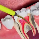 Lấy tủy răng có đau không? Quá trình điều trị được gây tê nên hầu như không đau.