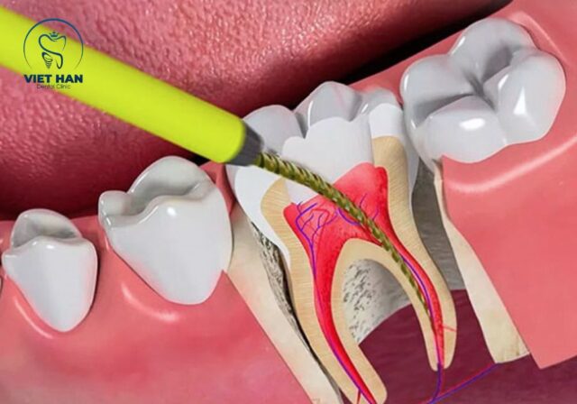 Lấy tủy răng có đau không? Quá trình điều trị được gây tê nên hầu như không đau.