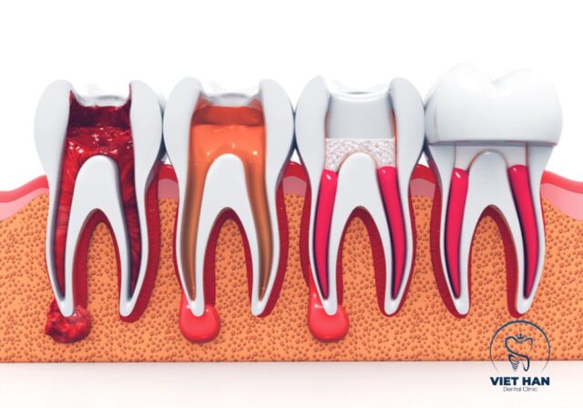 Sau khi lấy tủy răng có thể ê nhẹ vài ngày và sẽ giảm dần theo thời gian.