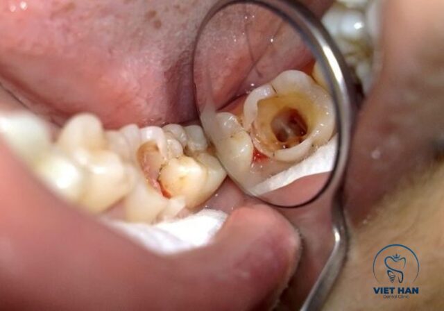 Sâu răng nặng, viêm tủy hoặc áp xe là những trường hợp cần lấy tủy răng.