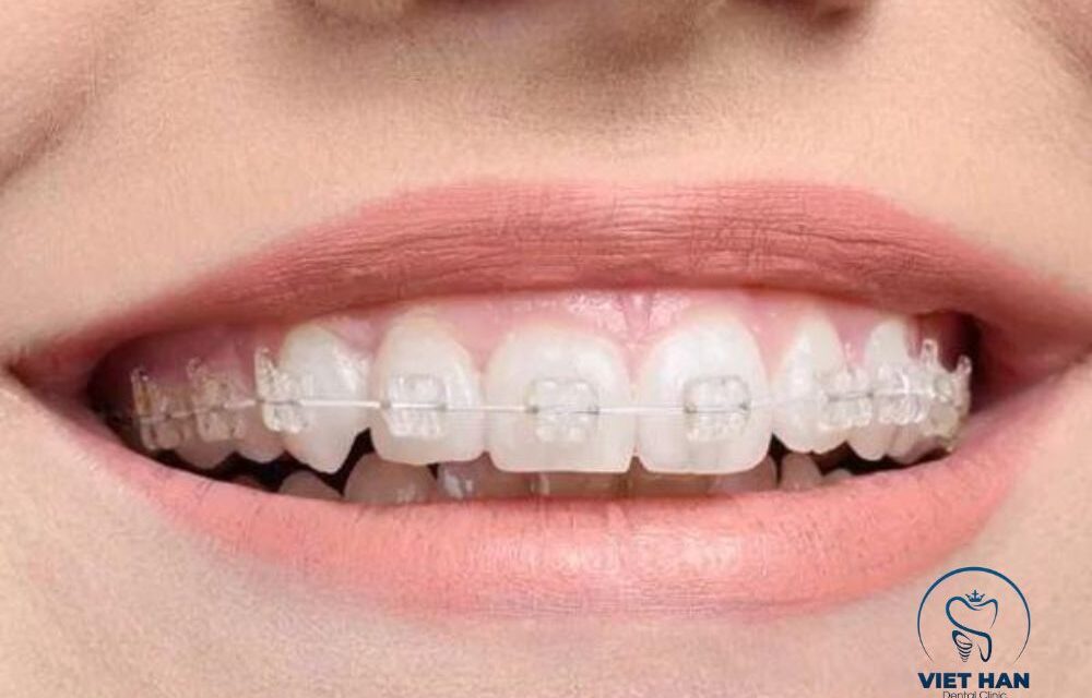 Niềng Răng Mắc Cài Sứ Có Tốt Không? Ưu Và Nhược Điểm Cần Biết