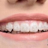 Niềng răng mắc cài sứ sử dụng mắc cài màu tương đồng với răng thật.