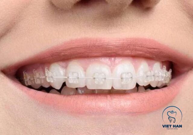 Niềng răng mắc cài sứ sử dụng mắc cài màu tương đồng với răng thật.