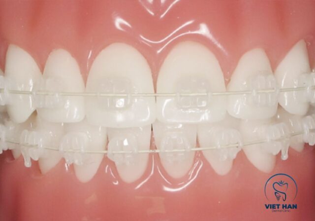 Niềng răng mắc cài sứ nổi bật với tính thẩm mỹ cao và hiệu quả chỉnh nha ổn định.