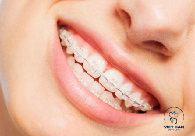 Mắc cài sứ có chi phí cao hơn và cần chăm sóc cẩn thận trong quá trình niềng.