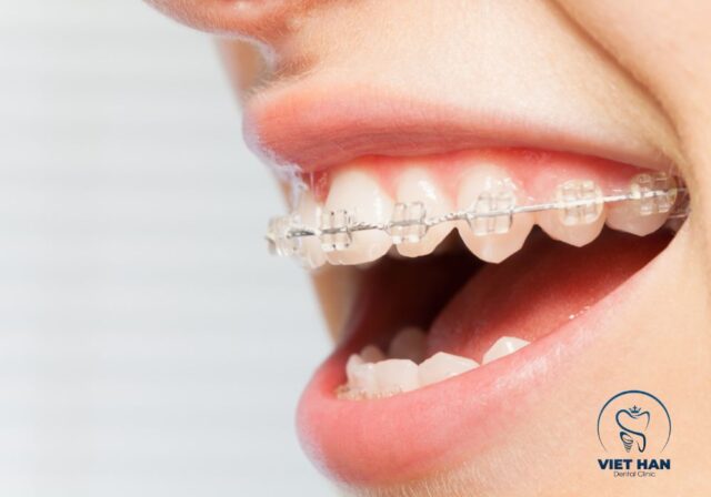 Chi phí niềng răng mắc cài sứ phụ thuộc vào tình trạng răng và phương pháp điều trị.