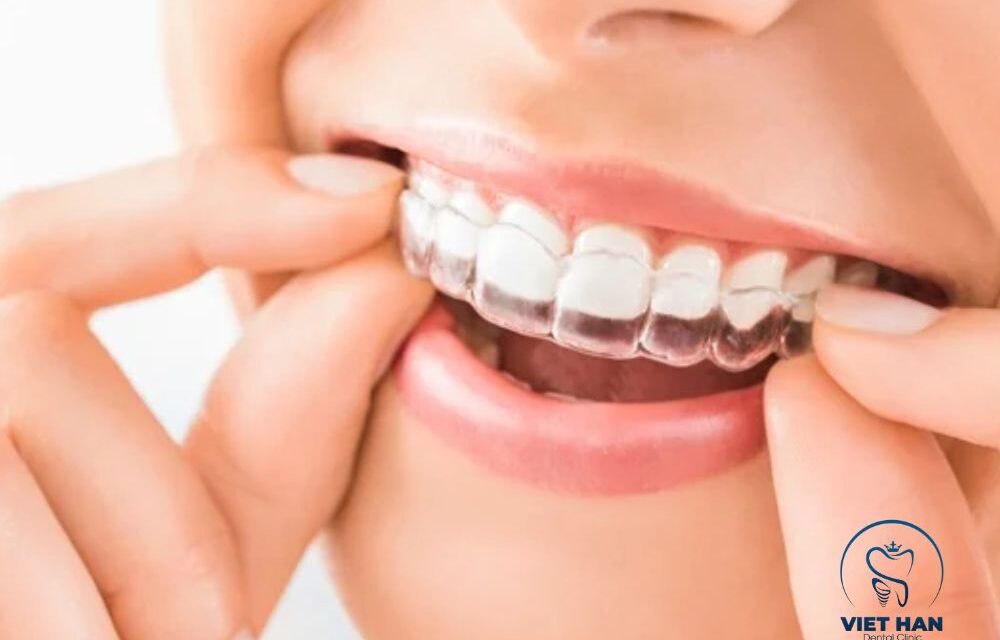 Niềng Răng Trong Suốt Hay Mắc Cài Tốt Hơn? So Sánh Chi Tiết