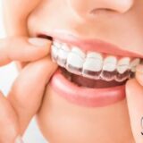 Niềng răng trong suốt sử dụng khay niềng trong suốt để dịch chuyển răng thẩm mỹ.