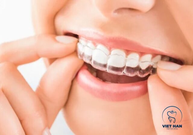 Niềng răng trong suốt sử dụng khay niềng trong suốt để dịch chuyển răng thẩm mỹ.