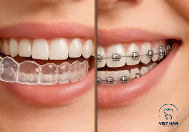 Khay niềng răng trong suốt được thiết kế cá nhân hóa theo từng giai đoạn dịch chuyển răng.