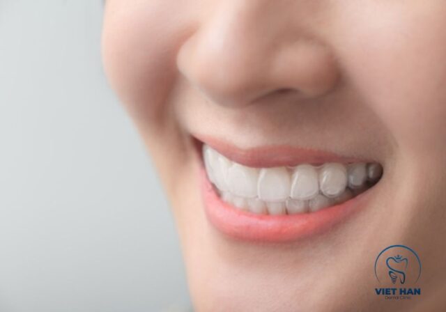 Niềng răng trong suốt có chi phí cao và cần đeo đủ thời gian mỗi ngày.