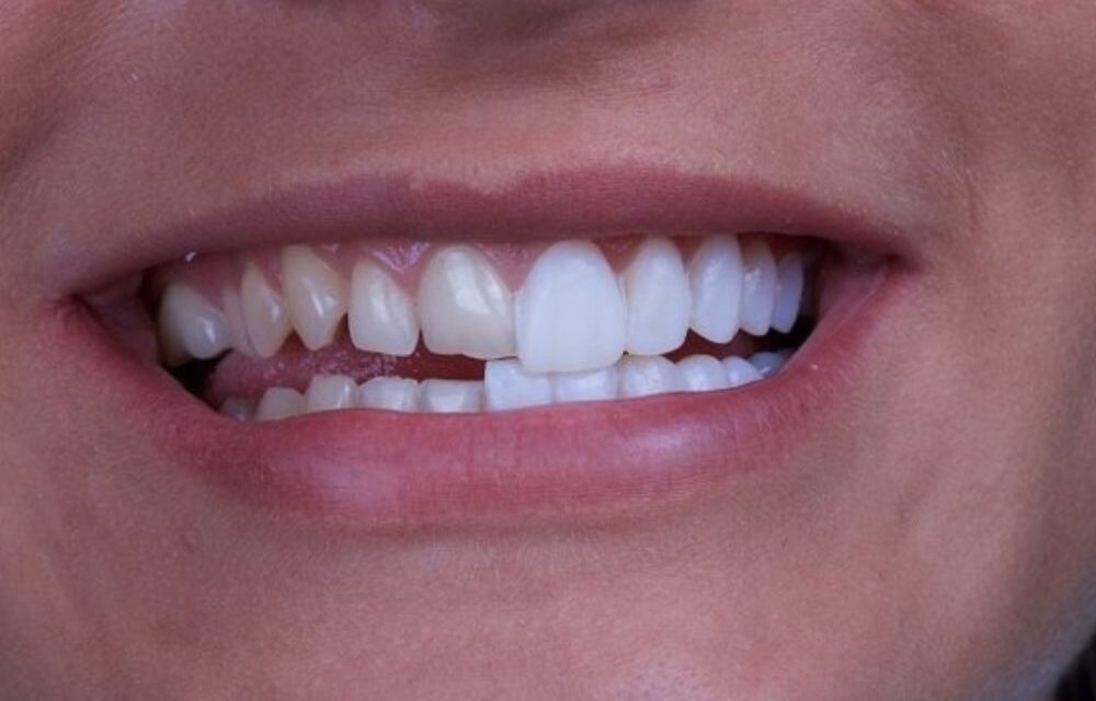 Dán sứ veneer có phải mài răng như bọc sứ không?
