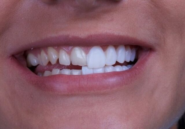 Dán sứ veneer chỉ mài một lớp men răng rất mỏng trong đa số trường hợp.