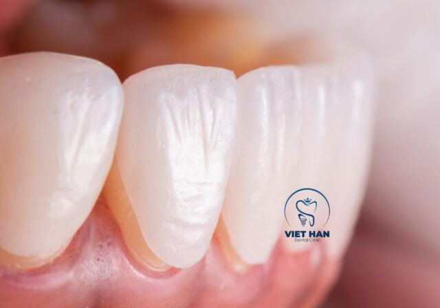 Mặt dán sứ veneer siêu mỏng ôm sát bề mặt răng sau khi phục hình.