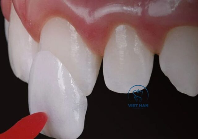 Dán sứ veneer giúp cải thiện thẩm mỹ và bảo tồn răng thật tối đa.