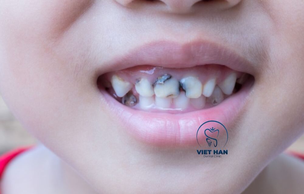 Răng Sâu Giai Đoạn Đầu: Dấu Hiệu Nhận Biết Sớm Và Cách Xử Lý