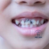 Lỗ sâu nhỏ trên bề mặt răng hình thành khi tổn thương men răng tiến triển.