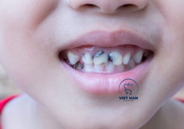 Lỗ sâu nhỏ trên bề mặt răng hình thành khi tổn thương men răng tiến triển.