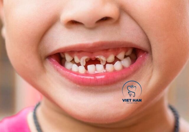 Vi khuẩn gây sâu răng phát triển trong mảng bám có thể khiến hơi thở có mùi khó chịu.