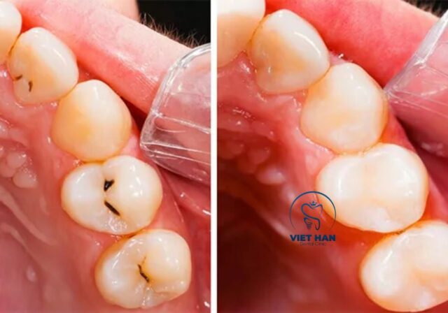 Trám răng là phương pháp điều trị phổ biến khi răng đã hình thành lỗ sâu.