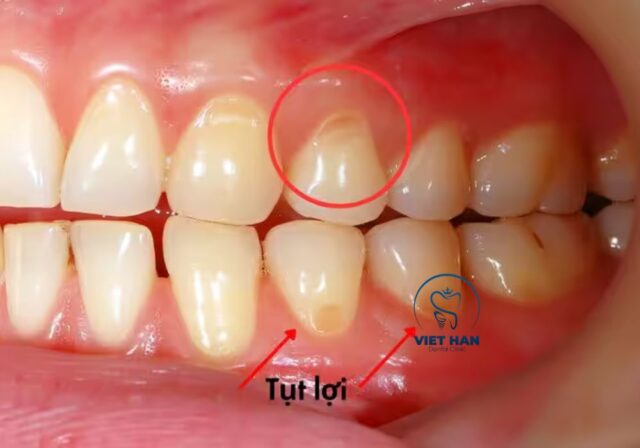 Tụt lợi chân răng khiến phần chân răng bị lộ ra ngoài.