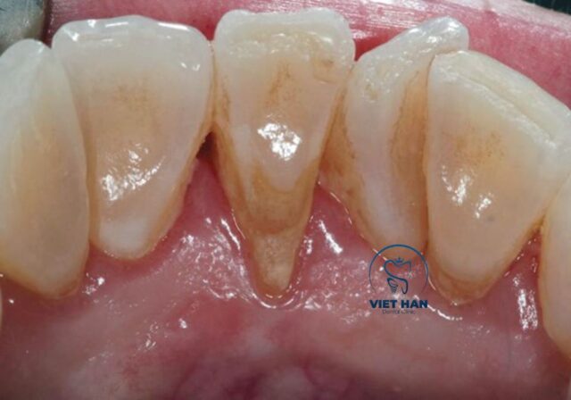 Chân răng lộ rõ là một trong những dấu hiệu dễ nhận biết của tụt lợi.