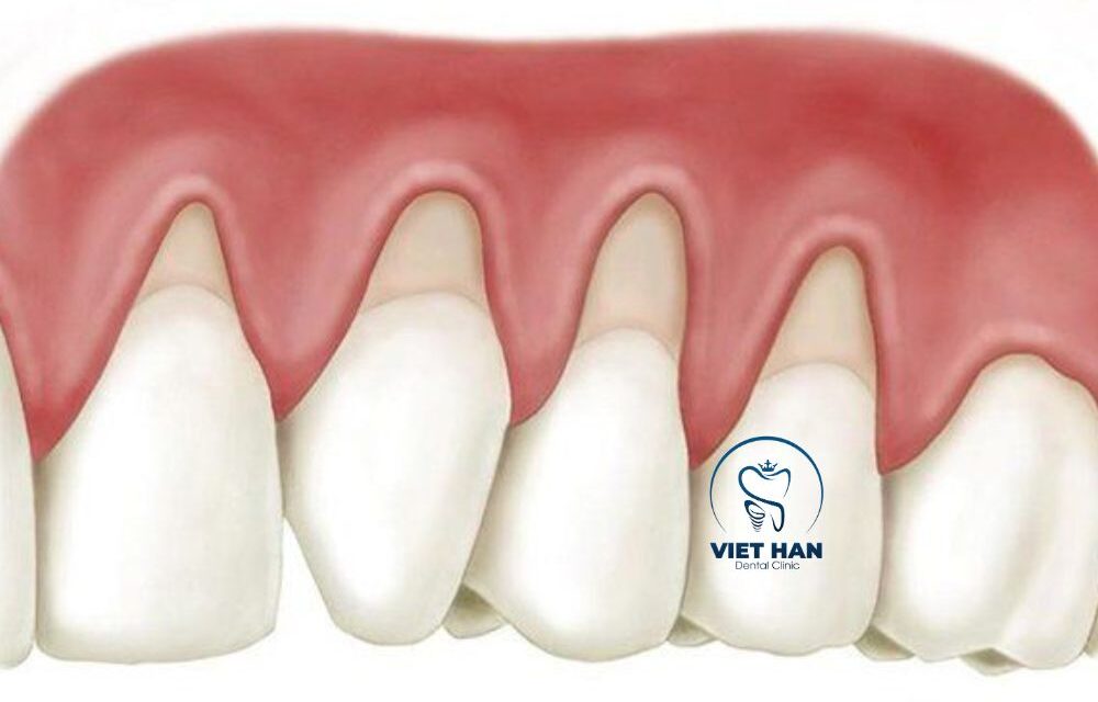 Tụt lợi chân răng và cách chữa hiệu quả giúp bảo vệ răng thật