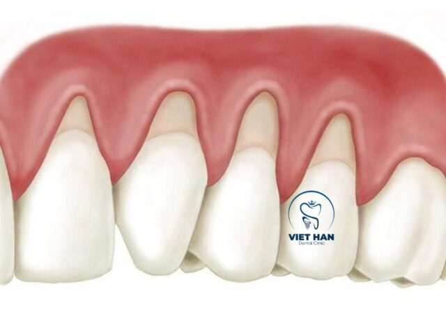 Cao răng tích tụ lâu ngày có thể gây viêm nướu và thúc đẩy tình trạng tụt lợi.