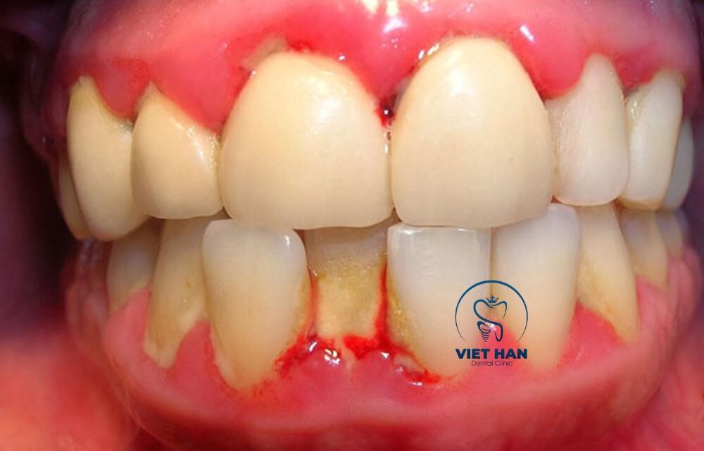 Dấu Hiệu Viêm Nha Chu Bạn Không Nên Bỏ Qua