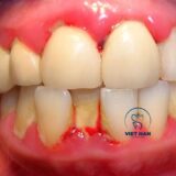 Viêm nha chu có thể gây tiêu xương ổ răng nếu không điều trị kịp thời.