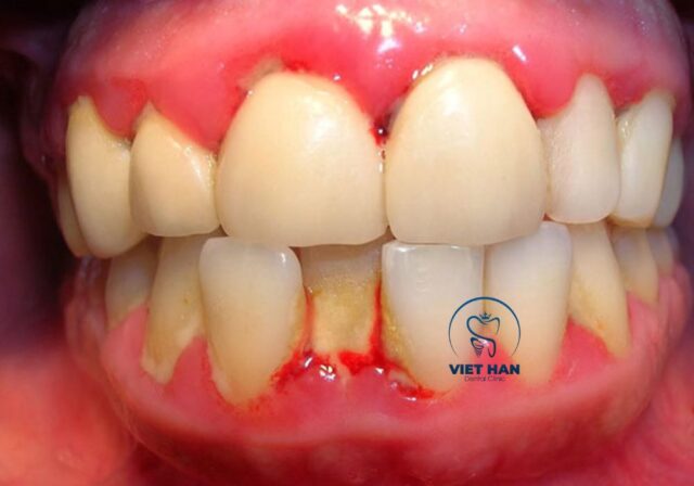 Viêm nha chu có thể gây tiêu xương ổ răng nếu không điều trị kịp thời.
