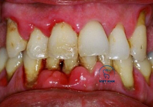 Viêm nha chu tiến triển có thể gây tụt nướu và lộ chân răng.