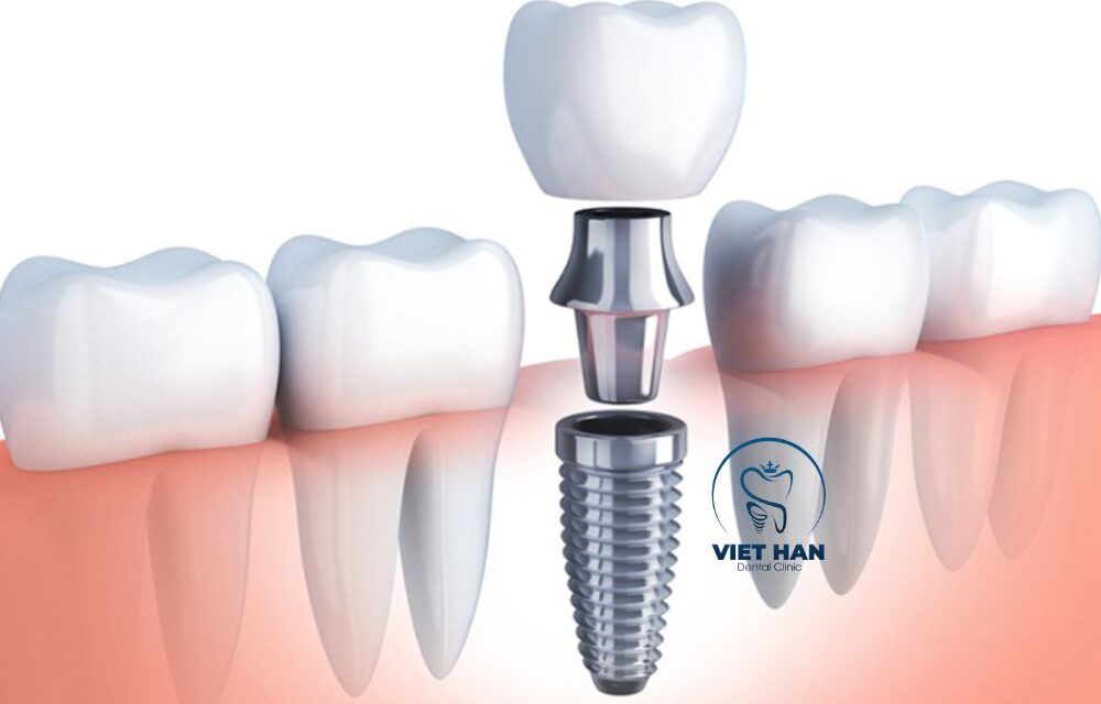 Trồng răng giả có mấy loại? Nên chọn phương pháp nào?