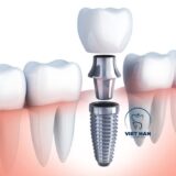 Trồng răng giả bằng phương pháp Implant