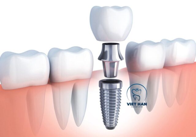 Trồng răng giả bằng phương pháp Implant