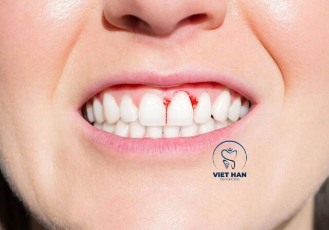 Viêm lợi là bệnh lý rất khó phân biệt với viêm nha chu