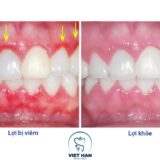 Sự khác nhau giữa lợi khỏe và viêm lợi.