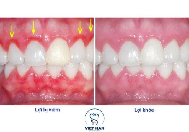 Sự khác nhau giữa lợi khỏe và viêm lợi.