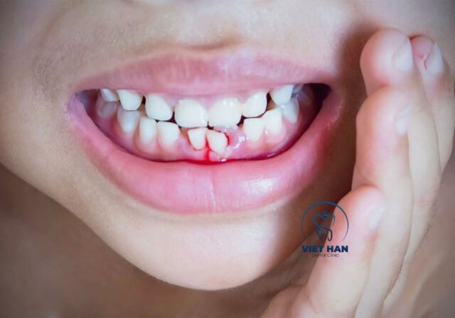 Điều trị viêm lợi ngay khi có dấu hiệu để tránh biến chứng.